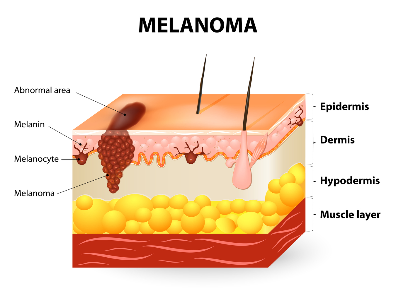 Causes Of Melanoma